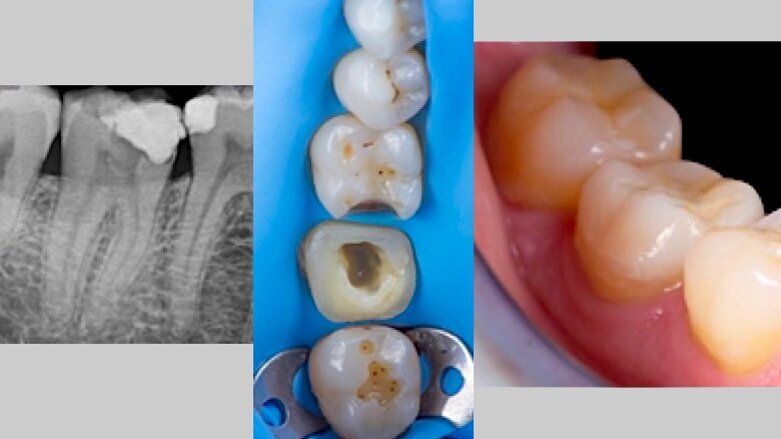 Manejo clínico de un tratamiento de conductos en 4.7
