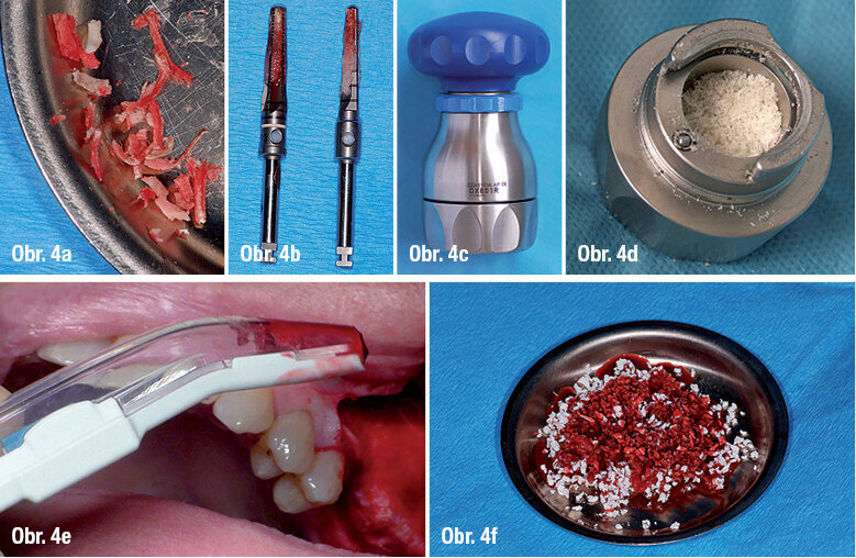 Běžné augmentační materiály Obr. 4a: kostní chipsy z lože implantátu, Obr. 4b: kostní fréza na dělení bloků, Obr. 4c: kostní mlýnek, Obr. 4d: namletá kost, Obr. 4e: kostní škrabka, Obr. 4f: komerční biomateriál