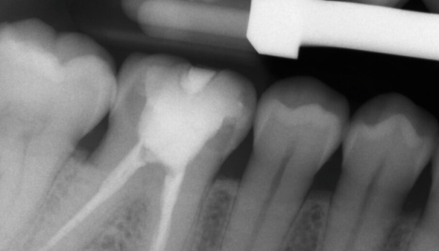 Fig. 13a: X-ray control image before and after the treatment
