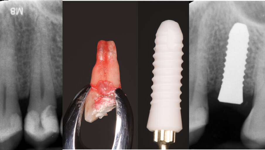Fig.  2 - Il collage delle immagini riporta inizialmente l’indagine radiografica iniziale con la stretta vicinanza al pavimento del seno ascellare oltre alla vitalità dell’elemento e all’assenza di infezioni peri-radicolari. La seconda distingue la radice rimossa, segue l’impianto che abbiamo scelto di posizionare e a destra si valuta il risultato del posizionamento impiantare con il rispetto del pavimento e la relazione ossea e inter-radicolare.