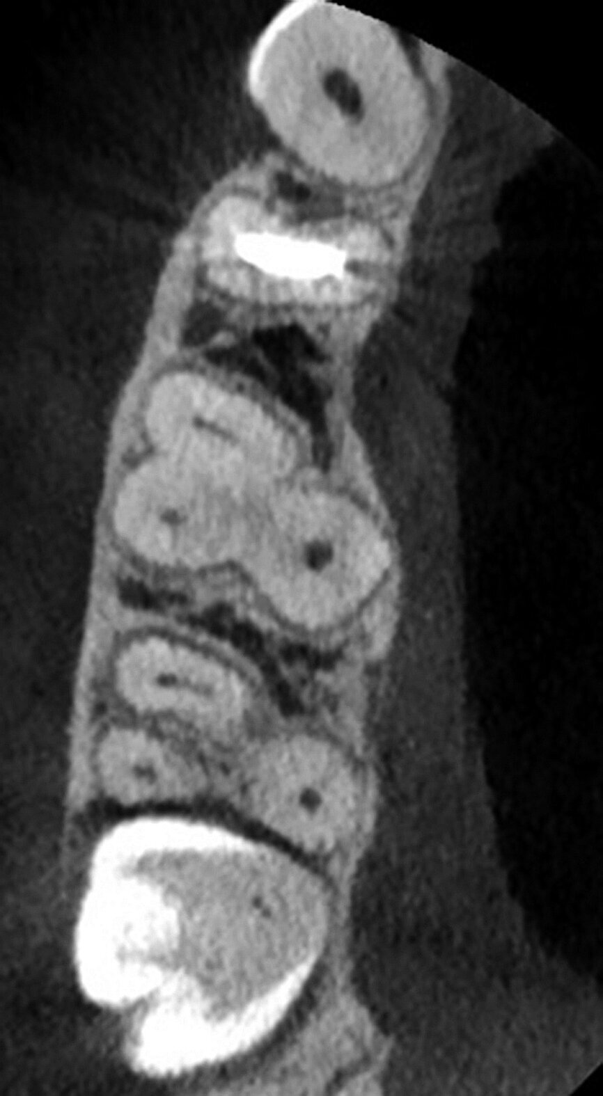 Fig. 4a: The imported scan can be reviewed in the axial (a), sagittal (b), and coronal (c) planes and the software presents a 3-D reconstruction view (d) where the transparency of the teeth can be changed.