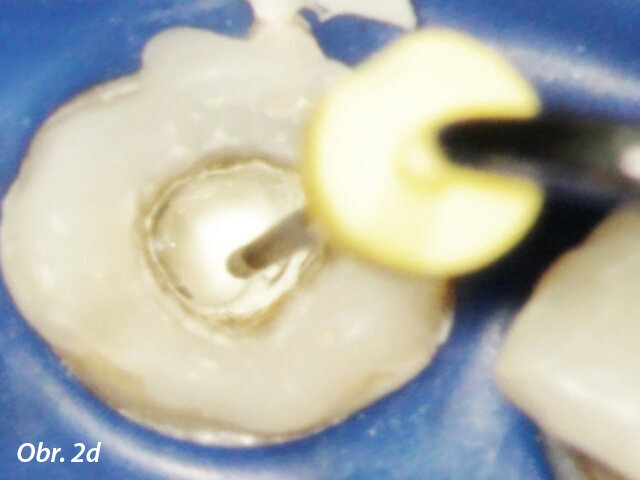 Kondenzace MTA pluggerem