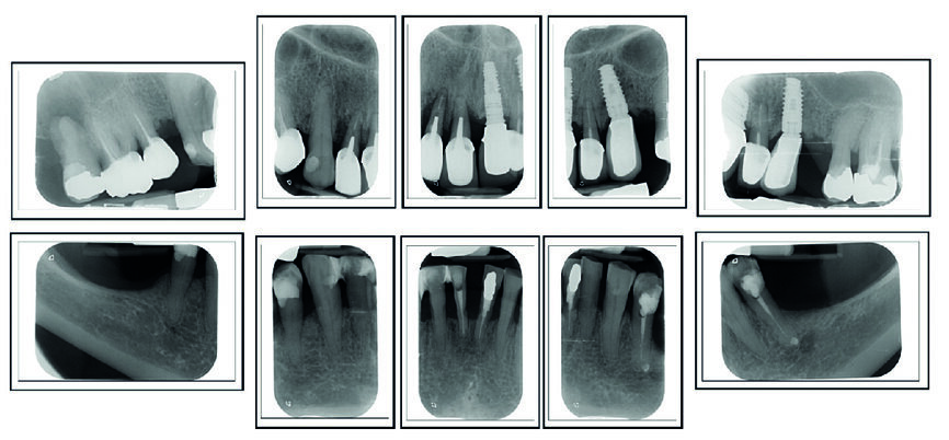 Fig. 2 : Bilan radiologique « long-cône ». Notez la sévérité des pertes d’attache, mais qui sont bien stabilisées depuis 12 ans.