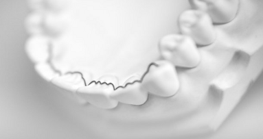 Retenedores linguales fabricados por CAD/CAM