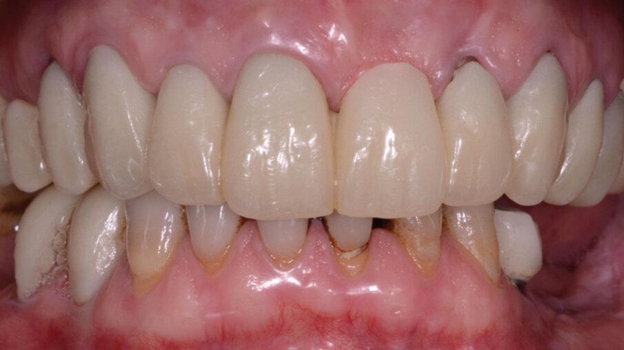 Fig. 4 - Primo provvisorio superiore.