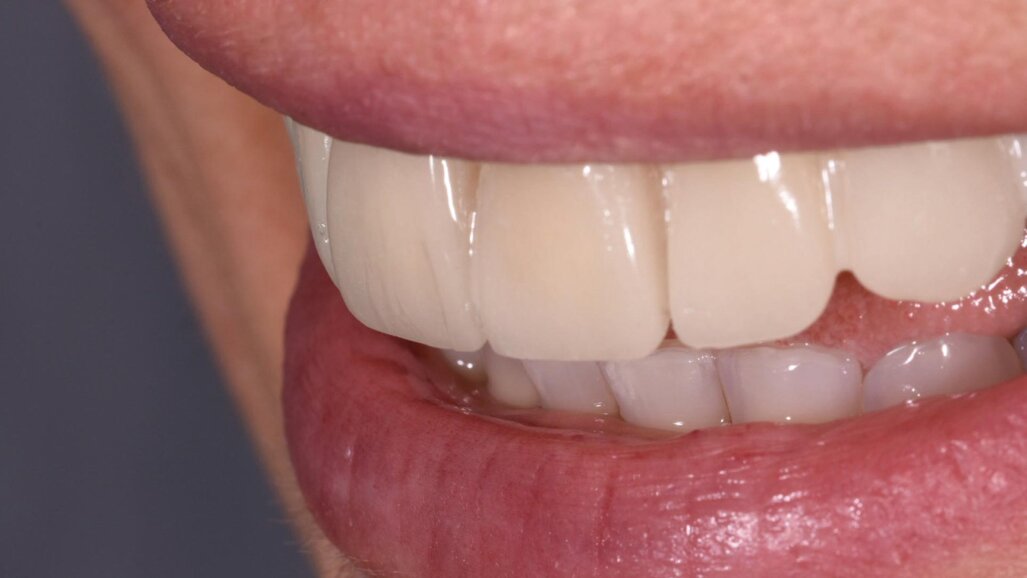 Ozonoterapia odontoiatrica ed estetica dentale: un connubio chimico e biologico