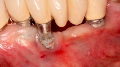 El láser en el tratamiento de la periimplantitis