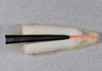 TECHOLE. One Step Fiber Post ovvero l’evoluzione della specie