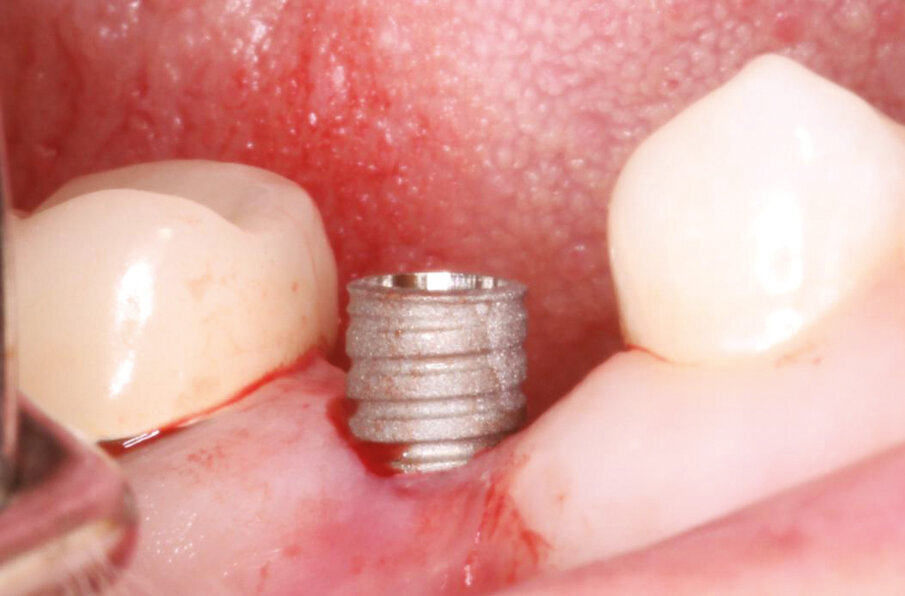 Fig.6: Implant placed flapless in #25. 