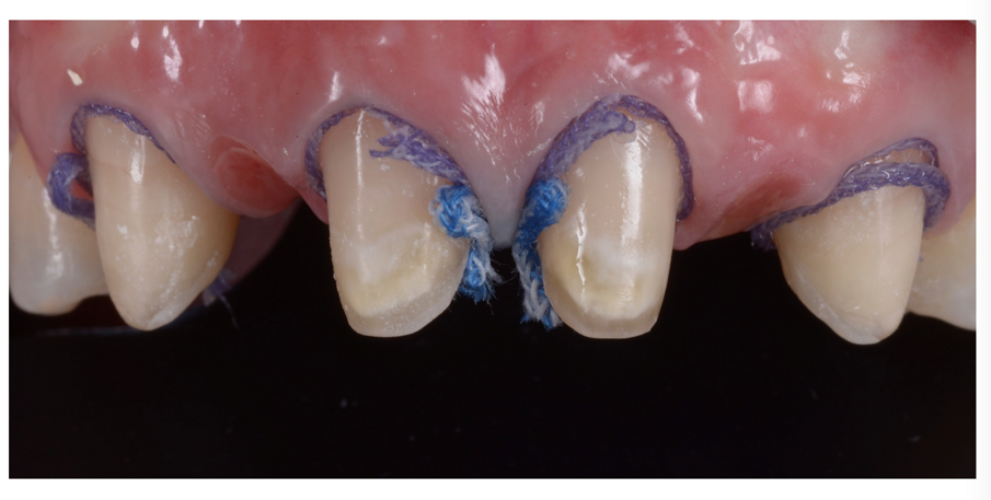 Fig. 18_Dopo detersione dei monconi ed inserimento dei fili retrattori, i tessuti sono già collassati.