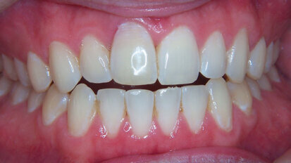 Immediate implantation and provisionalization: Single-tooth restoration in the esthetic zone Immediate implantation and provisionalization: Single-tooth restoration in the esthetic zone