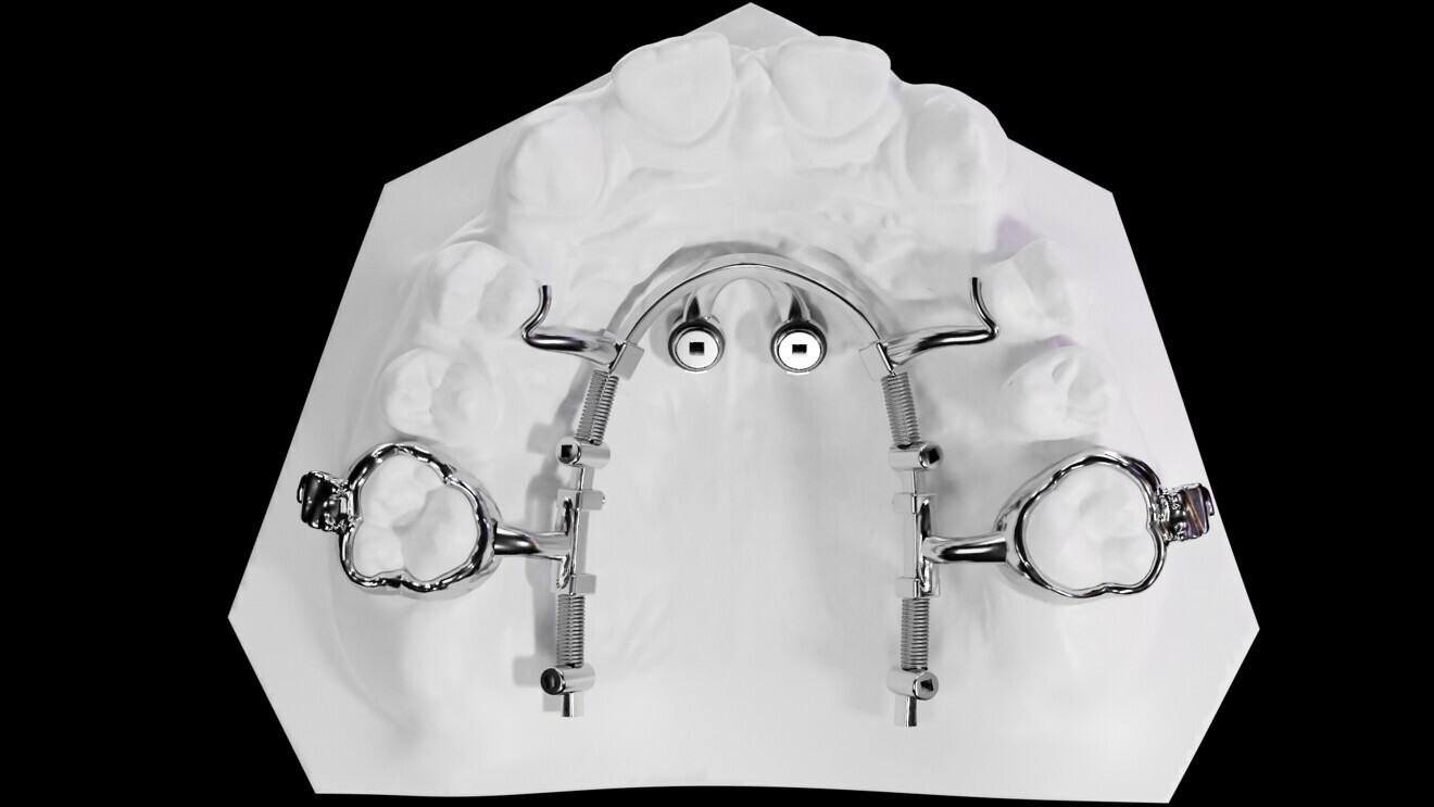 Fig. 3: CAD/CAM metal-printed Mesialslider.
