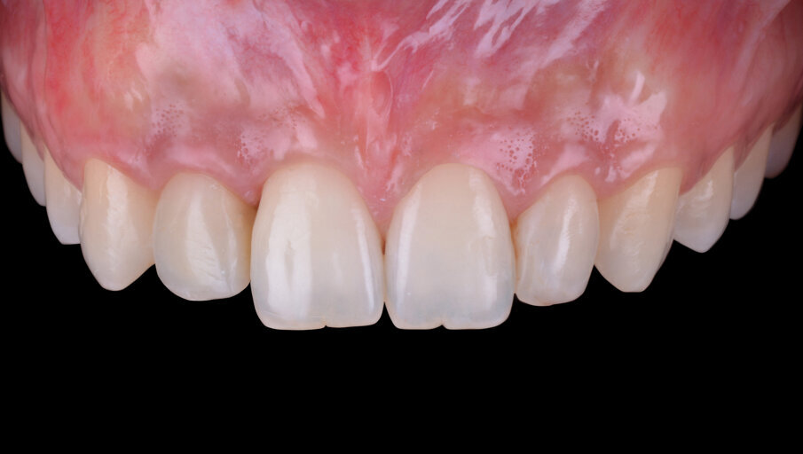 Fig. 13 - Maturazione dei tessuti molli dopo il condizionamento per mezzo di un provvisorio avvitato.