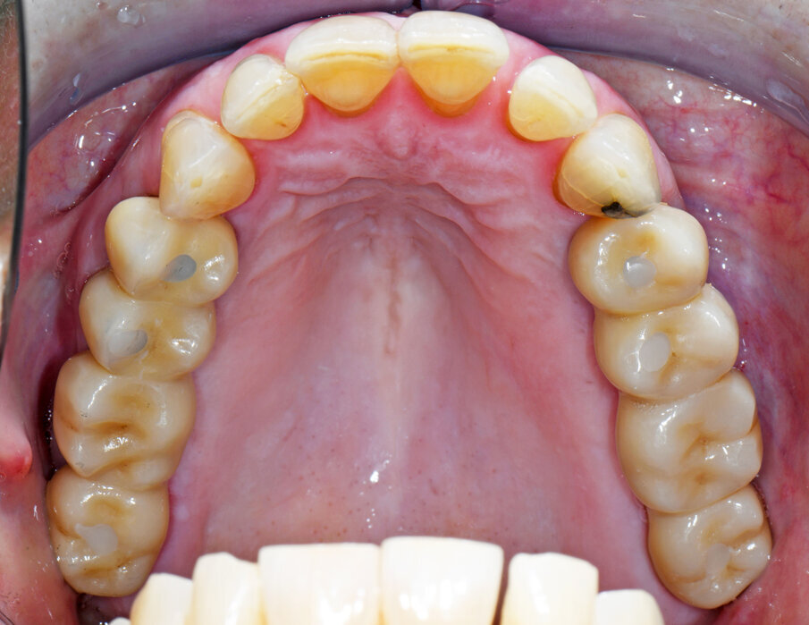 Obr. 13–18: Konstrukce Atlantis BridgeBase, zirkonové můstky a finální náhrady.