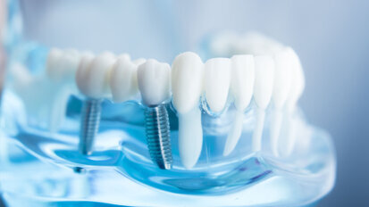 UCLA researchers develop technology to dramatically reduce peri-implantitis