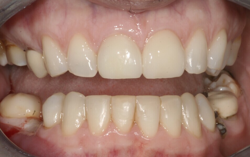 Fig. 6: 2004—after alignment of teeth #43–33 and direct edge bonding.