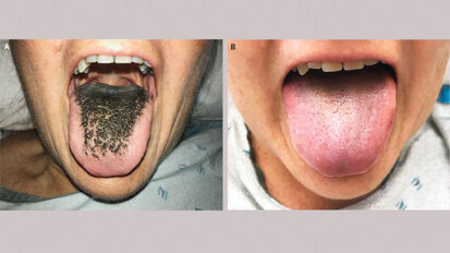 Rare case of black hairy tongue reported Rare case of black hairy tongue reported