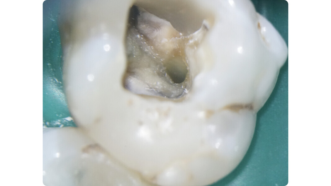 Fig. 32: Cleaned and shaped root canal system.