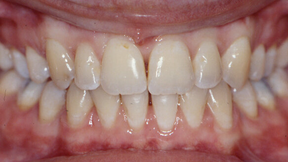 Harmonization of the dento-facial complex