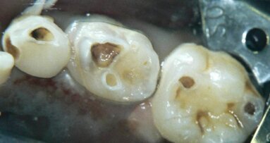 סילוק עששת סלקטיבי בנגעי עששת עמוקים לעומת סילוק עששת בשני שלבים