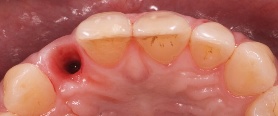 Fig. 8: Clinical situation after four months of healing after removal of the provisional restoration. 