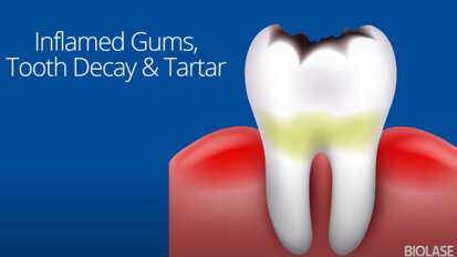 Biolase – Fix Cavities with Waterlase Dental Lasers Biolase – Fix Cavities with Waterlase Dental Lasers