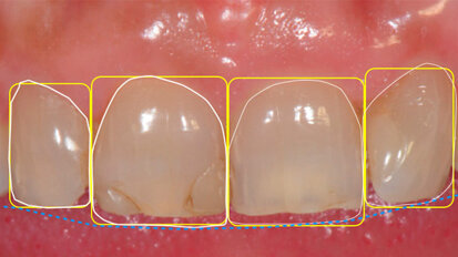 La programmazione  del ringiovanimento  del sorriso