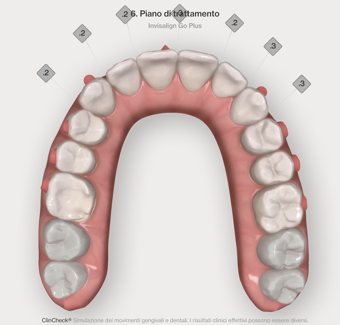 Figg. 4–7 - Pianificazione digitale nelle due arcate prima (Figg. 4, 5) e dopo (Figg. 6, 7). I numeri nel quadrato indicano la riduzione interprossimale pianificata.