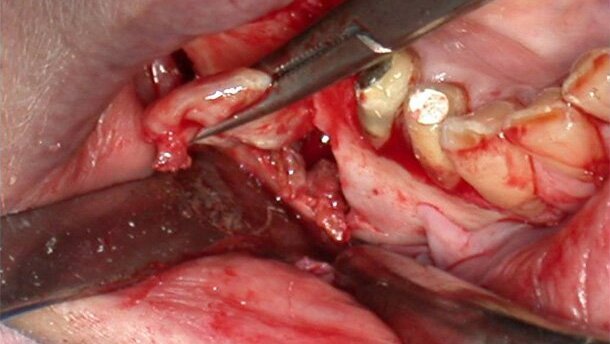 Spontaneous bone regeneration after removal of cysts: One-year follow-up of 336 consecutive cases