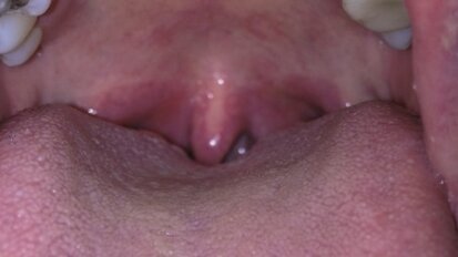 Laserowe leczenie chrapania i bezdechu sennego