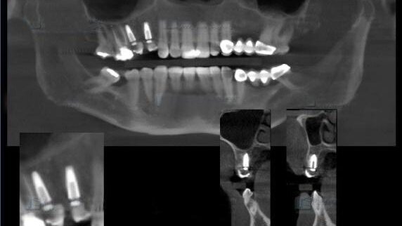 Colocación de implantes con LOCimplant System