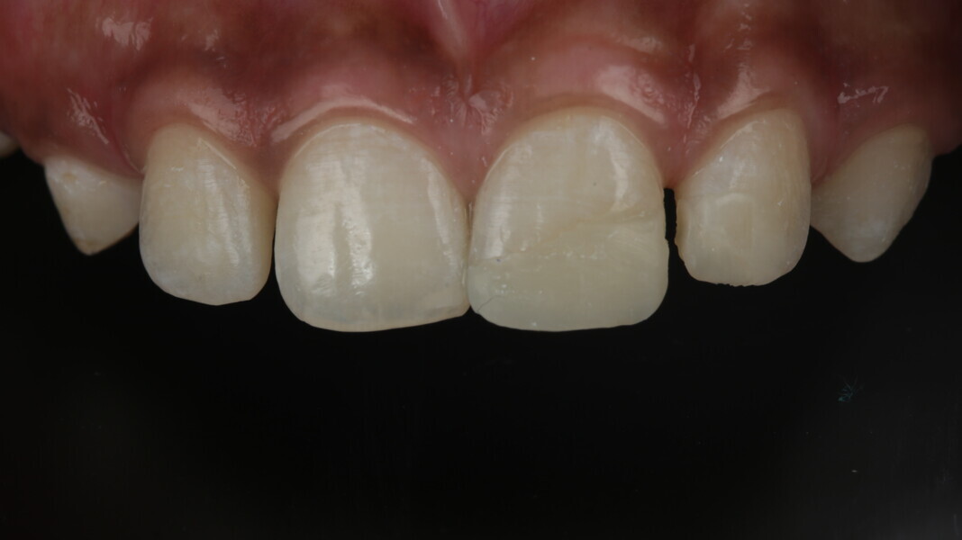 Fig 5: Quick intra-oral mock-up was performed without etching and bonding. This can also be done with the chosen shades of composite to roughly evaluate the selected shade. 