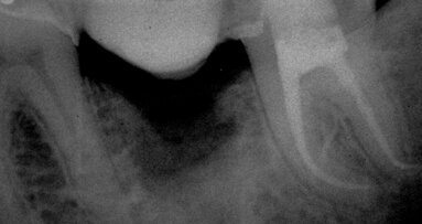 The interrelationships between complex canal anatomy and the instruments that shape them
