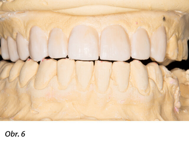 Funkční analýza wax-upu