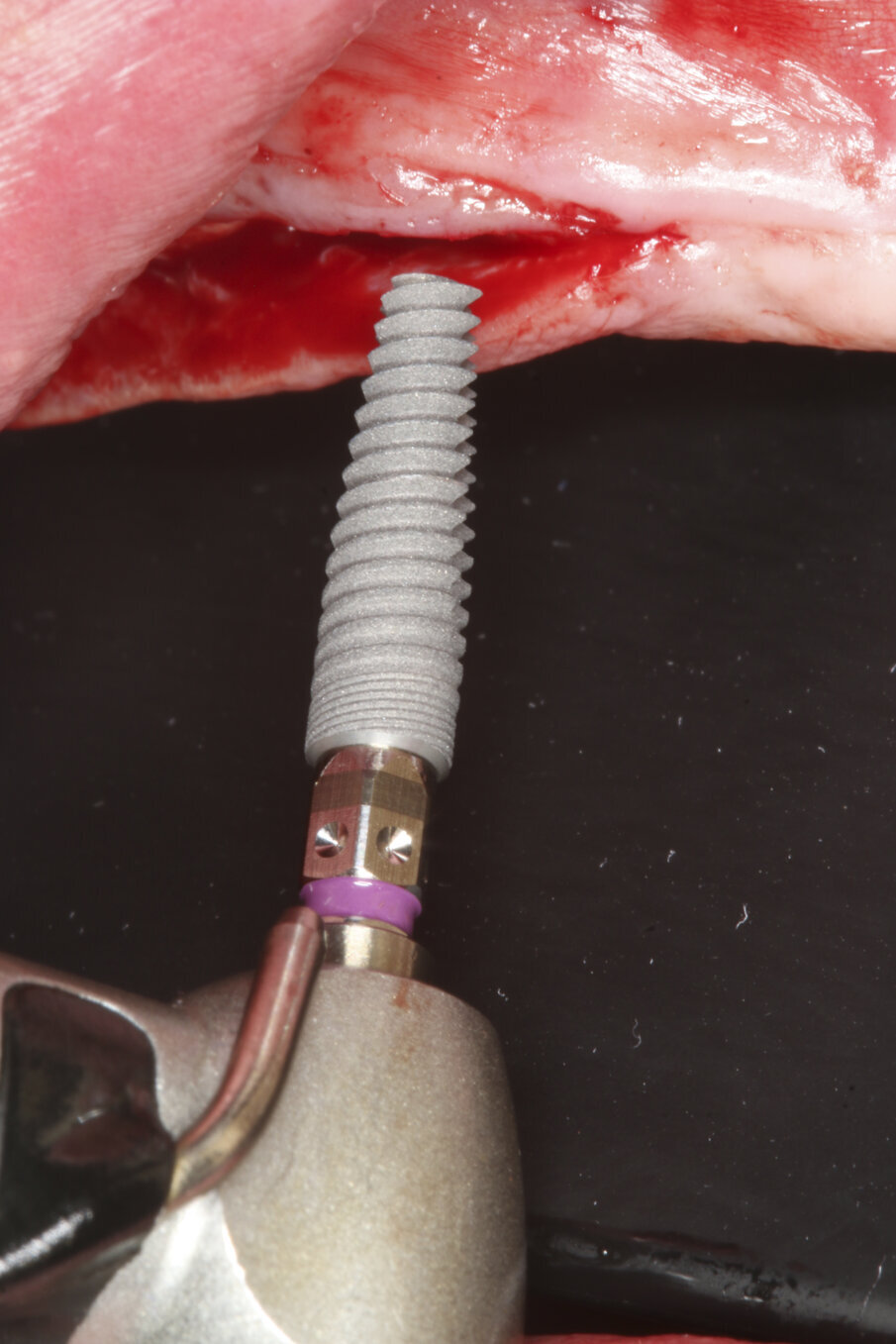 Fig. 6: Implant insertion.