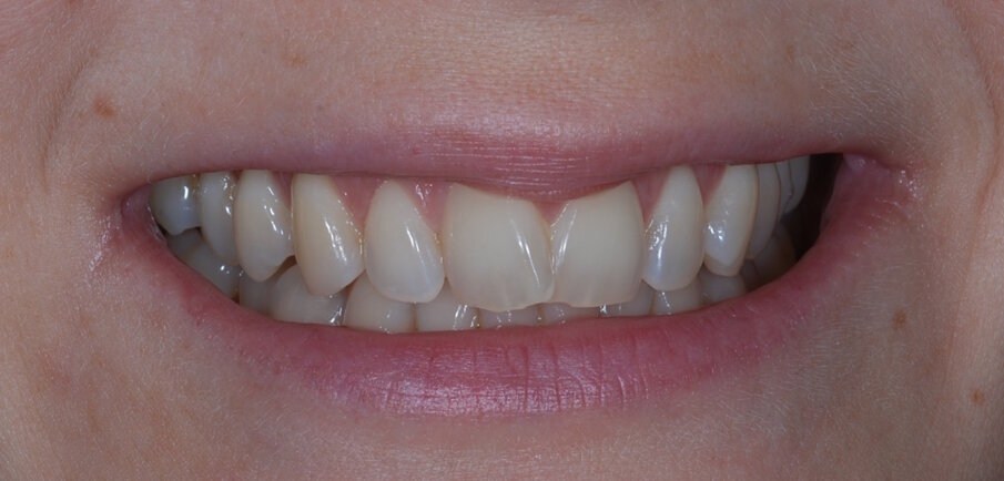 Fig. 1: Pre treatment anterior