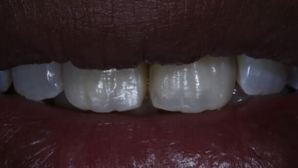 Bringing anterior direct restorations to life using surface textures