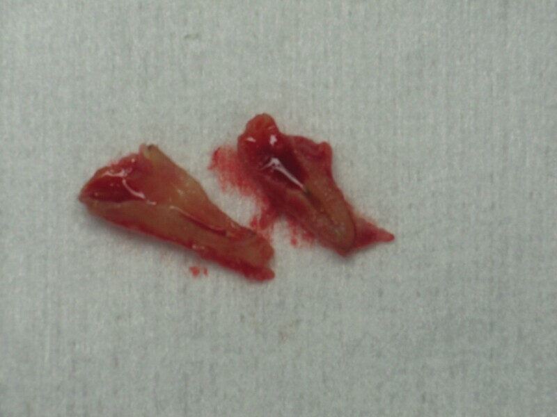 Fig. 1 : Fracture radiculaire mise en évidence après extraction. 