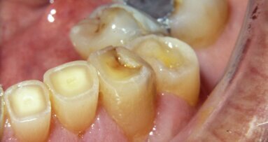 דיאטה אינה האשמה היחידה בגרימת ארוזיה בשיניים