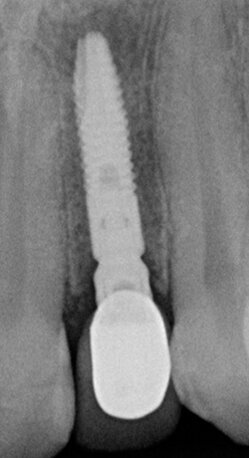 Fig. 6b - Controllo radiografico a un mese.