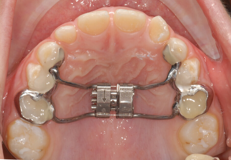 Fig. 23_Cementazione Leaf expander full digital.