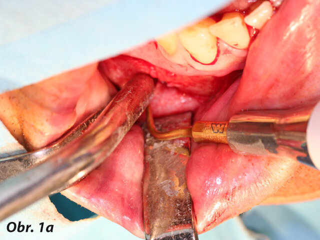 Chirurgická extrakce radixu relicta v blízkosti výstupu nervus mentalis