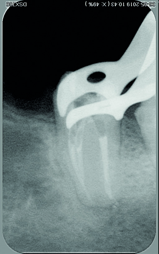 Figs. 15 et 16 : Radiographie après obturation. 