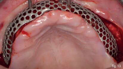 Riabilitazione di un mascellare gravemente atrofico mediante approccio digitale