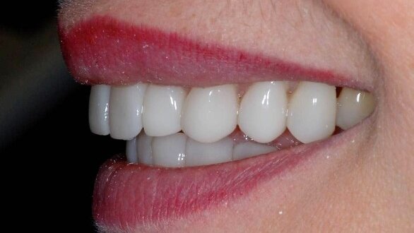 Licówki porcelanowe GlamSmile nakładane na zęby dolne i górne. Analiza kliniczna – Część 1