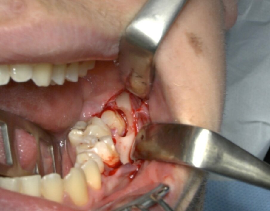Fig. 7_Ostectomia completata.