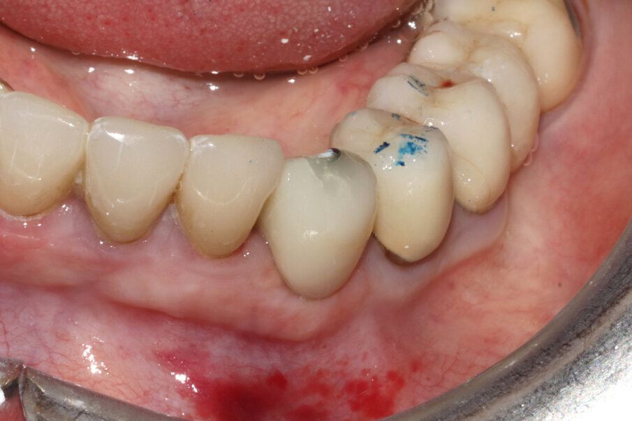 Figg. 9-11_Inserimento dell’impianto e costruzione di una corona provvisoria. Si noti la forma a “C” dello shield e, al termine dell’intervento, la compostezza dei tessuti, gestiti senza alcun tipo di lembo.