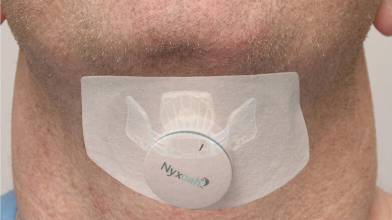 Mit Zungenschrittmacher gegen Schlafapnoe