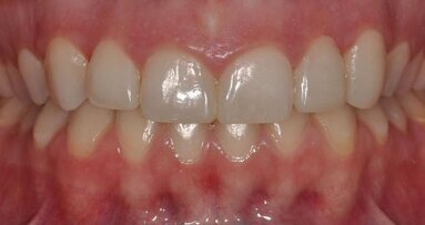 Enhancement of aesthetic treatment planning and communication using a diagnostic mock-up