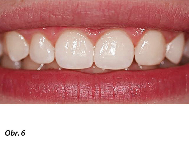 Nevyhnutelná stranová nesouměrnost.